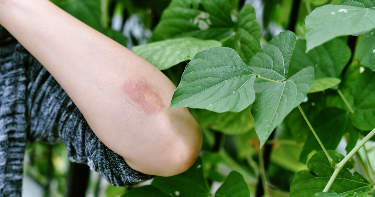 Considerations for Using Plants That Can Cause Skin Irritation NewPro