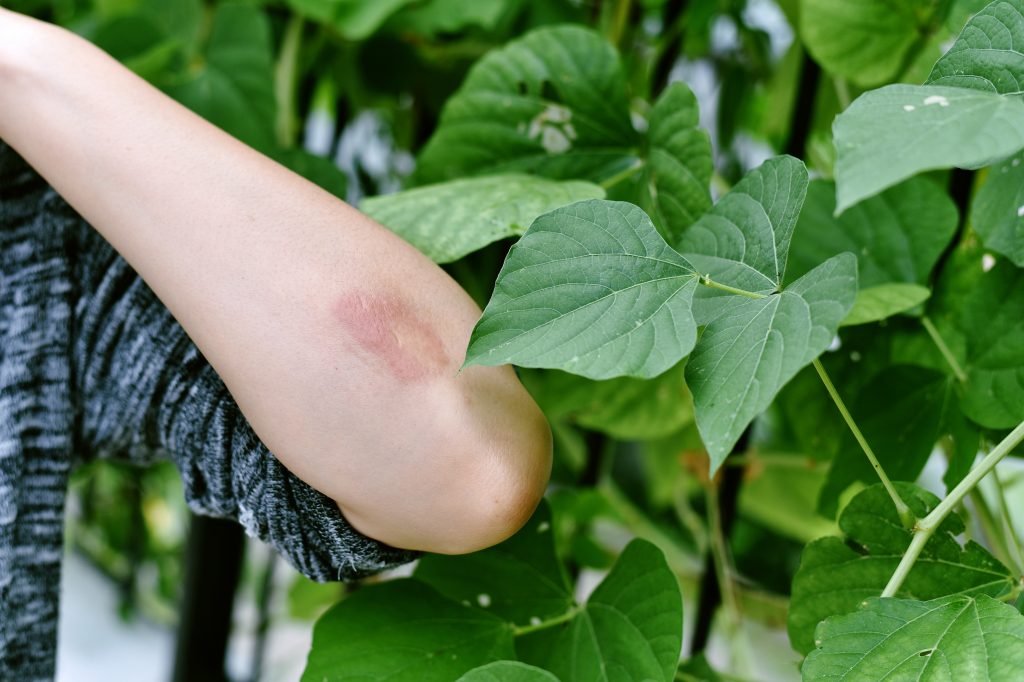 arm brushing up against plants that cause skin irritation